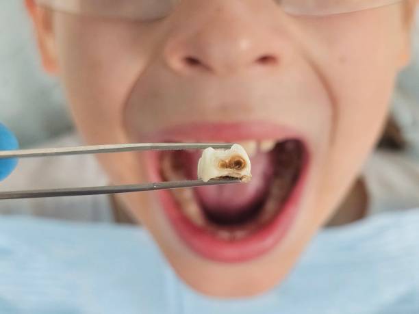Best Emergency Wisdom Teeth Removal in Anchorage, AK